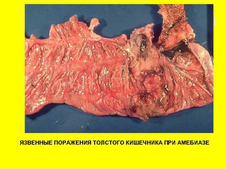 ЯЗВЕННЫЕ ПОРАЖЕНИЯ ТОЛСТОГО КИШЕЧНИКА ПРИ АМЕБИАЗЕ 
