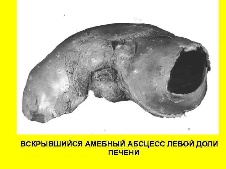 ВСКРЫВШИЙСЯ АМЕБНЫЙ АБСЦЕСС ЛЕВОЙ ДОЛИ ПЕЧЕНИ 
