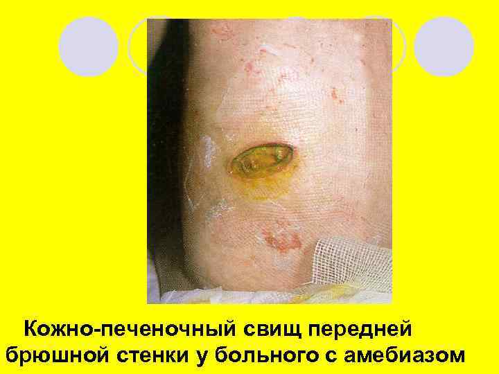 Кожно-печеночный свищ передней брюшной стенки у больного с амебиазом 