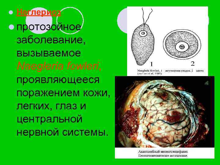 l Неглериоз l протозойное заболевание, вызываемое Naegleria fowleri, проявляющееся поражением кожи, легких, глаз и