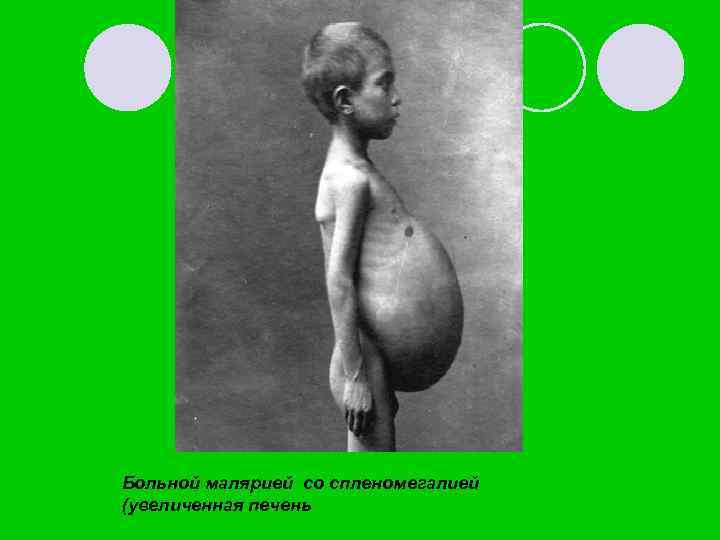 Больной малярией со спленомегалией (увеличенная печень 