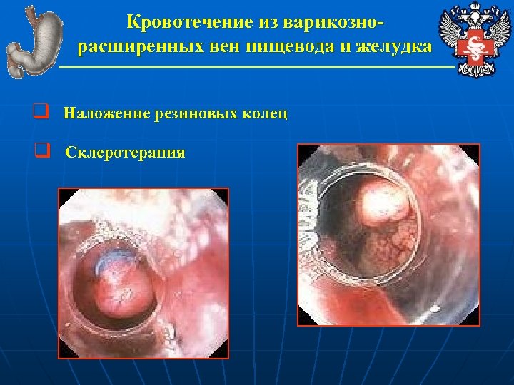 Кровотечение из варикознорасширенных вен пищевода и желудка q Наложение резиновых колец q Склеротерапия 