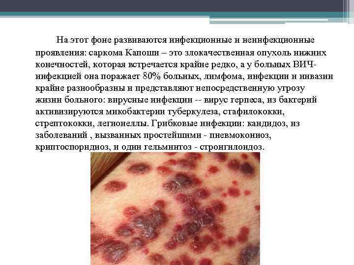 На этот фоне развиваются инфекционные и неинфекционные проявления: саркома Капоши – это злокачественная опухоль