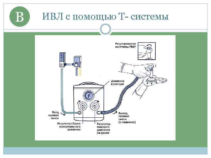 B ИВЛ с помощью Т- системы 