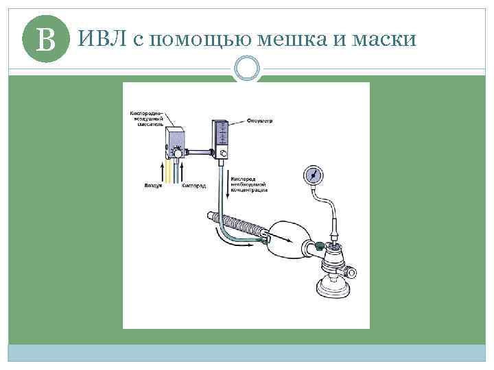 B ИВЛ с помощью мешка и маски 