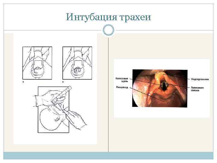 Интубация трахеи 