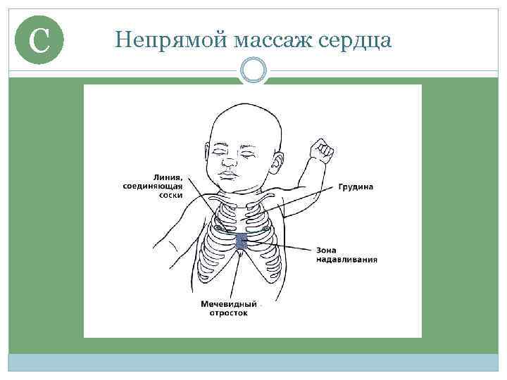 C Непрямой массаж сердца 