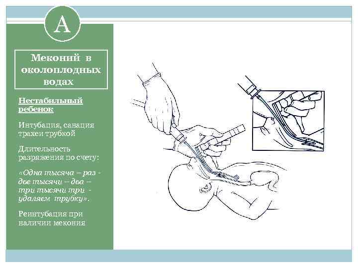 A Меконий в околоплодных водах Нестабильный ребенок Интубация, санация трахеи трубкой Длительность разряжения по