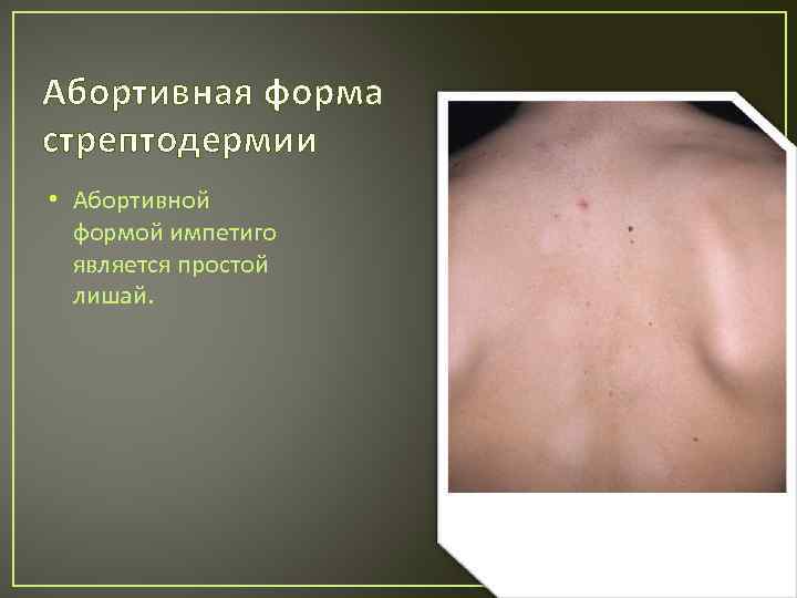 Абортивная форма стрептодермии • Абортивной формой импетиго является простой лишай. 
