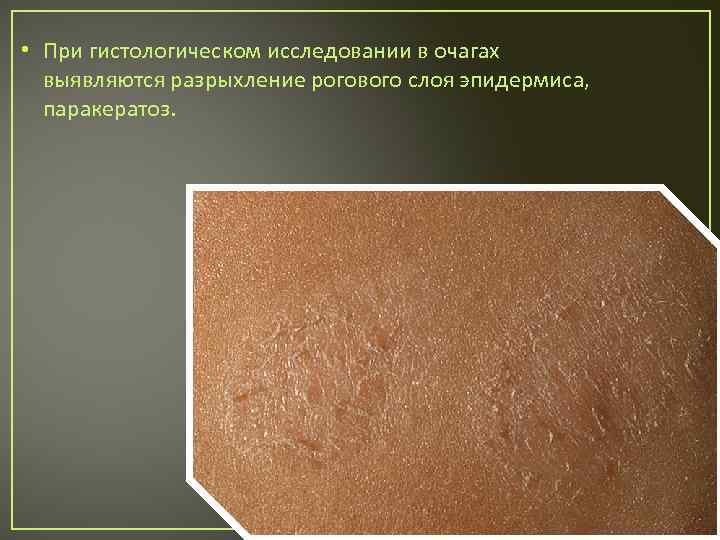  • При гистологическом исследовании в очагах выявляются разрыхление рогового слоя эпидермиса, паракератоз. 