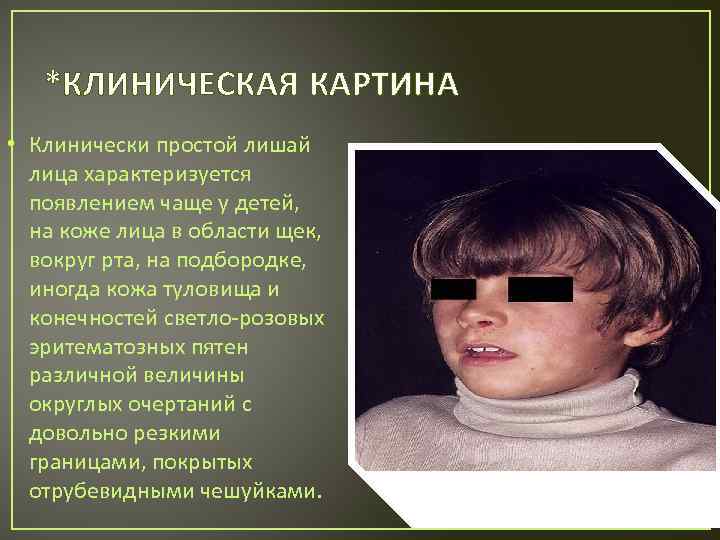 *КЛИНИЧЕСКАЯ КАРТИНА • Клинически простой лишай лица характеризуется появлением чаще у детей, на коже