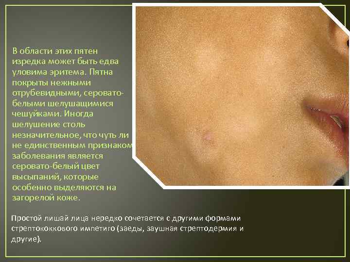 В области этих пятен изредка может быть едва уловима эритема. Пятна покрыты нежными отрубевидными,