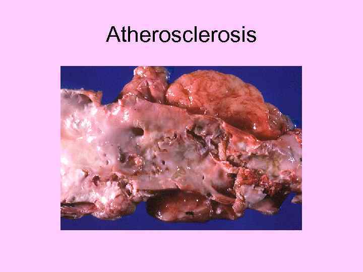 Atherosclerosis 