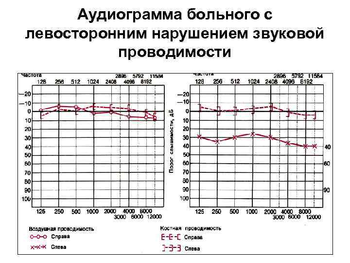 Аудиограмма больного с левосторонним нарушением звуковой проводимости 