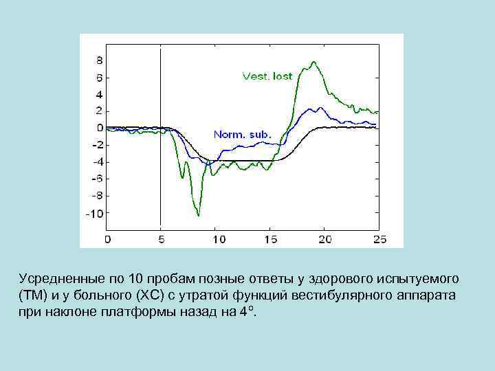 Усредненные по 10 пробам позные ответы у здорового испытуемого (ТМ) и у больного (ХС)