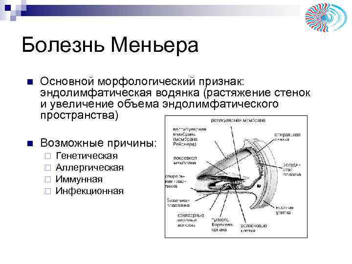 Болезнь Меньера n Основной морфологический признак: эндолимфатическая водянка (растяжение стенок и увеличение объема эндолимфатического