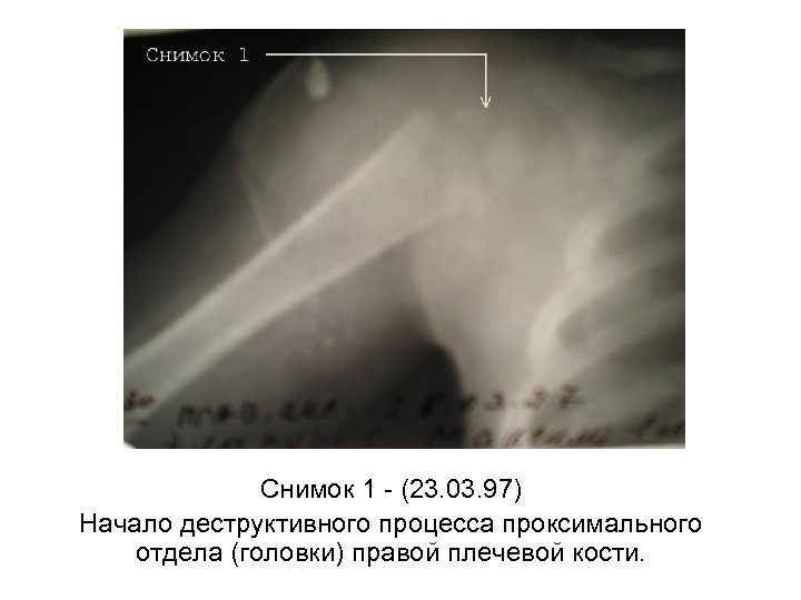 Снимок 1 - (23. 03. 97) Начало деструктивного процесса проксимального отдела (головки) правой плечевой