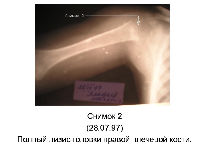 Снимок 2 (28. 07. 97) Полный лизис головки правой плечевой кости. 