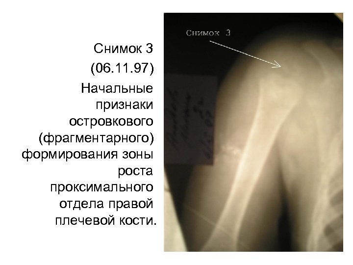 Снимок 3 (06. 11. 97) Начальные признаки островкового (фрагментарного) формирования зоны роста проксимального отдела