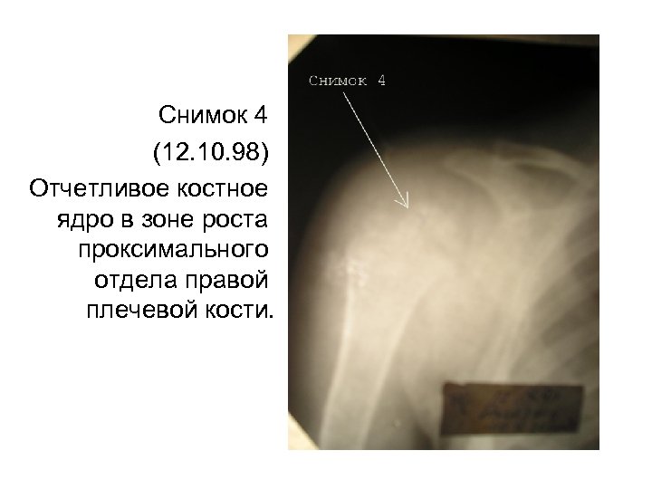 Снимок 4 (12. 10. 98) Отчетливое костное ядро в зоне роста проксимального отдела правой