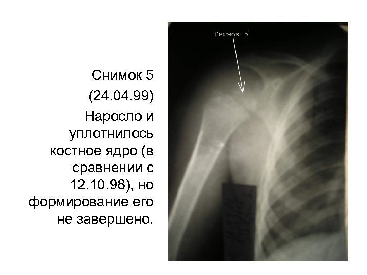 Снимок 5 (24. 04. 99) Наросло и уплотнилось костное ядро (в сравнении с 12.