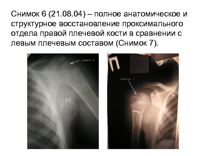 Снимок 6 (21. 08. 04) – полное анатомическое и структурное восстановление проксимального отдела правой