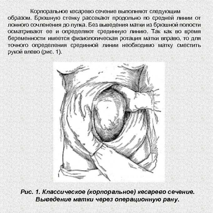 Корпоральное кесарево сечение выполняют следующим образом. Брюшную стенку рассекают продольно по средней линии от