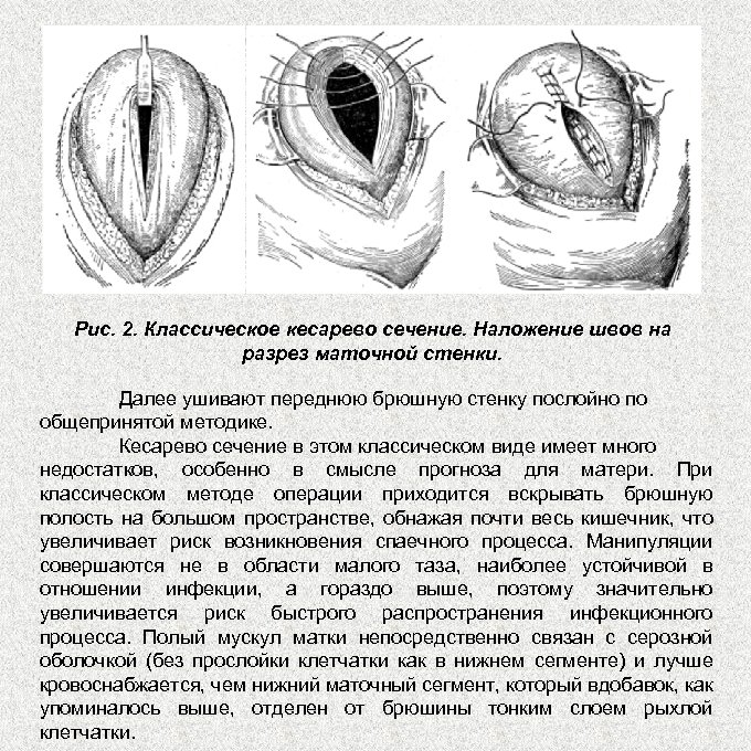 Согласие на кесарево сечение образец