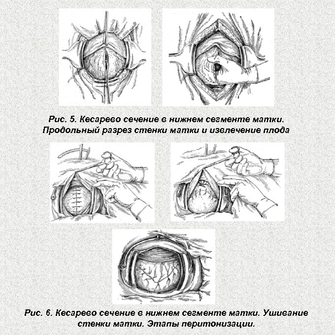 Рис. 5. Кесарево сечение в нижнем сегменте матки. Продольный разрез стенки матки и извлечение