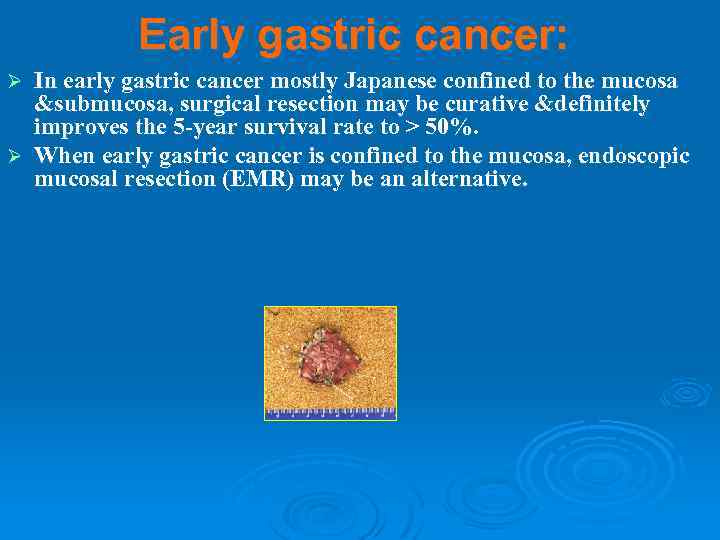 Early gastric cancer: In early gastric cancer mostly Japanese confined to the mucosa &submucosa,