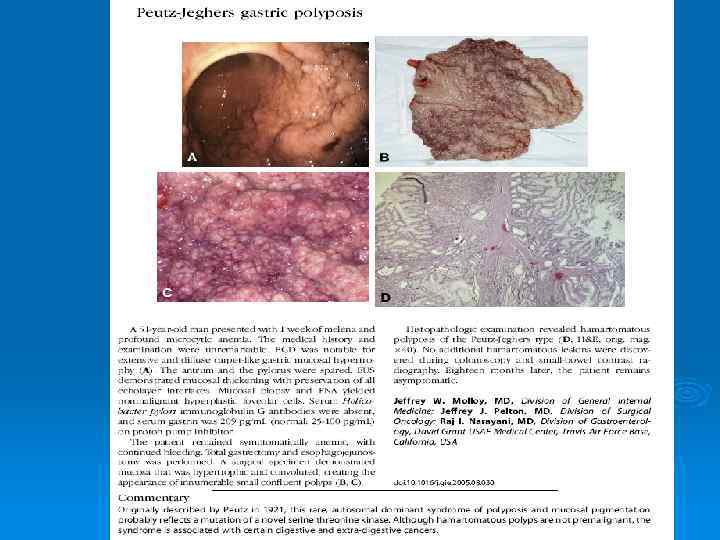 BENIGN TUMORS: 