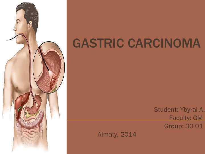 GASTRIC CARCINOMA Student: Ybyrai A. Faculty: GM Group: 30 -01 Almaty, 2014 