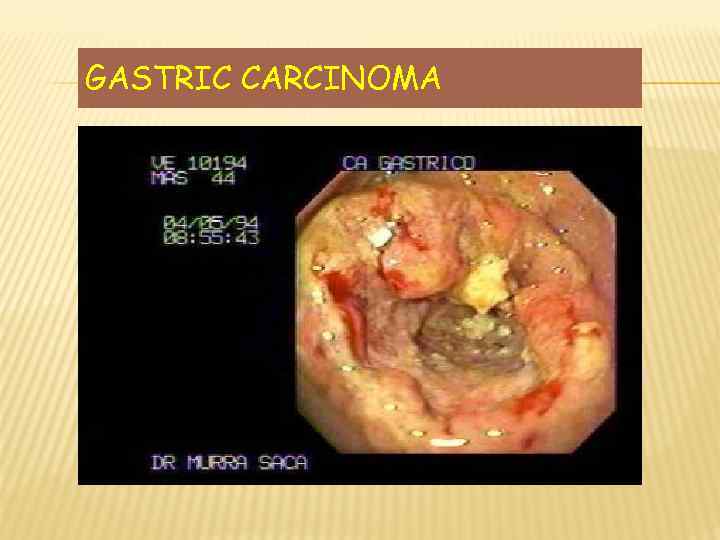 GASTRIC CARCINOMA 