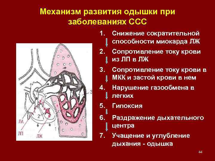 Механизм развития одышки при заболеваниях ССС 1. Снижение сократительной способности миокарда ЛЖ 2. Сопротивление