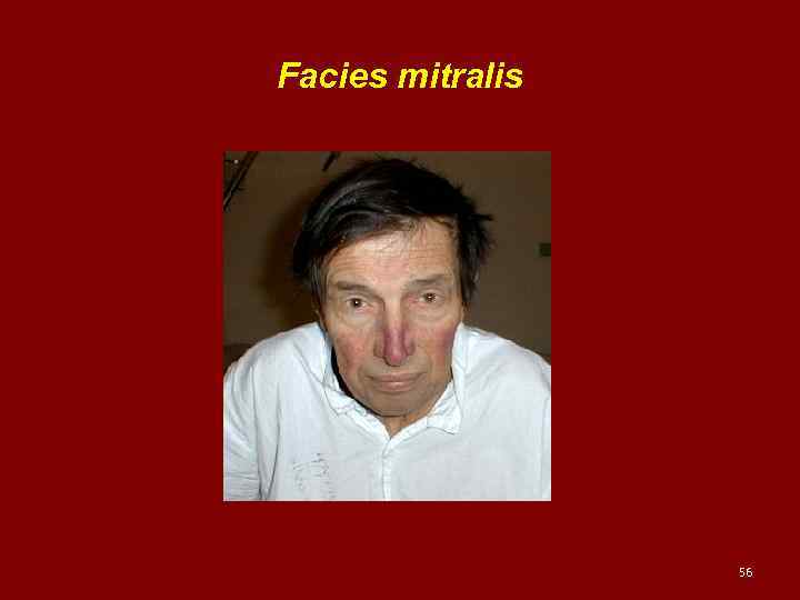 Facies mitralis 56 