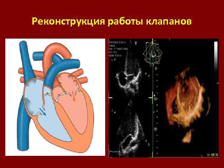Реконструкция работы клапанов 