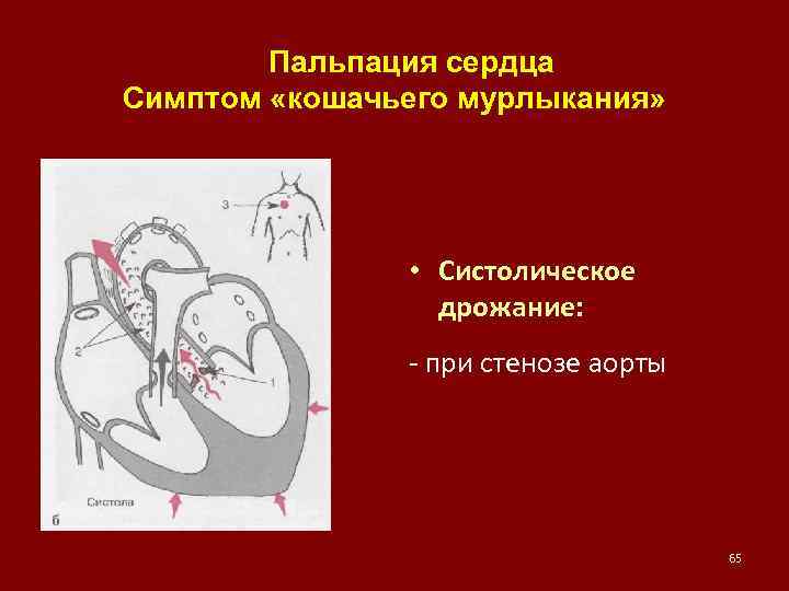  Пальпация сердца Симптом «кошачьего мурлыкания» • Систолическое дрожание: - при стенозе аорты 65