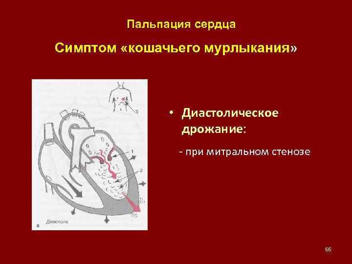 Пальпация сердца Симптом «кошачьего мурлыкания» • Диастолическое дрожание: - при митральном стенозе 66 