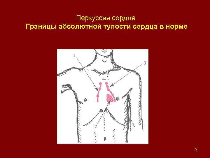 Перкуссия сердца Границы абсолютной тупости сердца в норме 73 