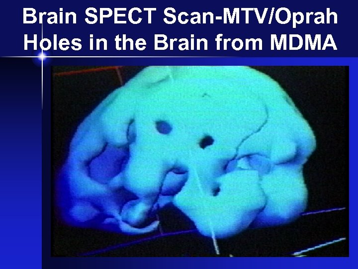 Brain SPECT Scan-MTV/Oprah Holes in the Brain from MDMA 