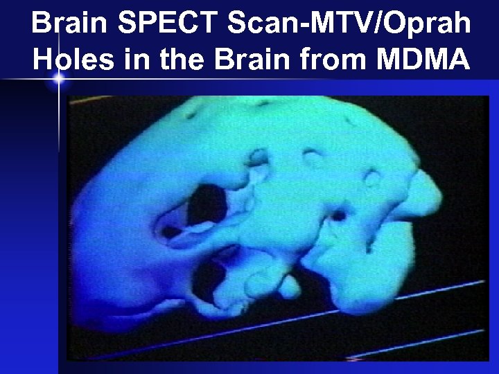 Brain SPECT Scan-MTV/Oprah Holes in the Brain from MDMA 