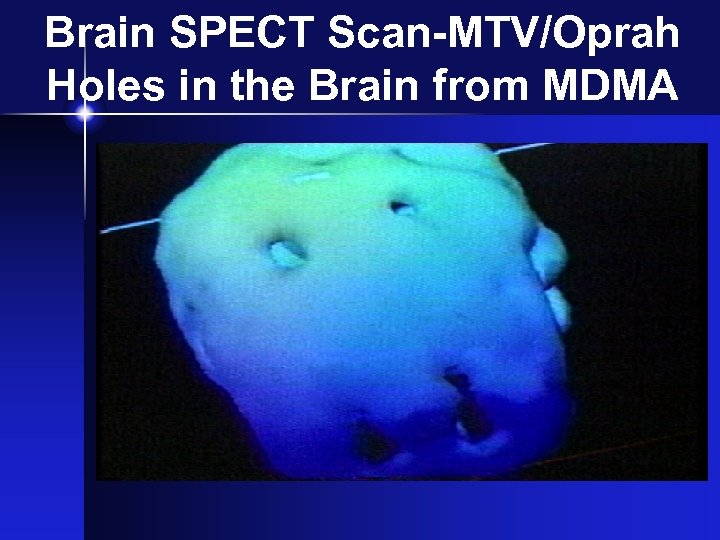 Brain SPECT Scan-MTV/Oprah Holes in the Brain from MDMA 