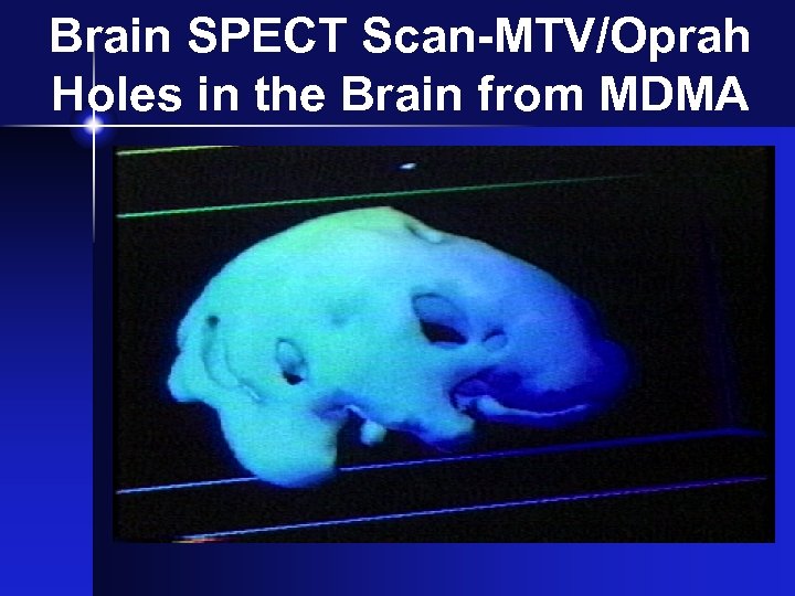 Brain SPECT Scan-MTV/Oprah Holes in the Brain from MDMA 