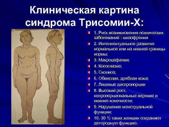 Клиническая картина синдрома Трисомии-X: 1. Риск возникновения психических заболеваний : шизофрения 2. Интеллектуальное развитие