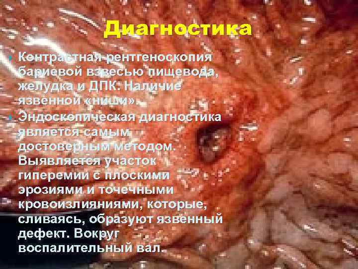 Диагностика Контрастная рентгеноскопия бариевой взвесью пищевода, желудка и ДПК. Наличие язвенной «ниши» . Эндоскопическая