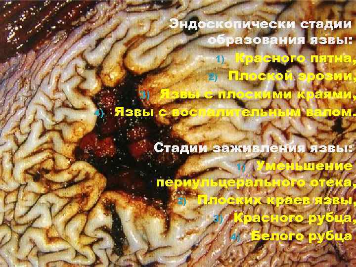 4) Эндоскопически стадии образования язвы: 1) Красного пятна, 2) Плоской эрозии, 3) Язвы с