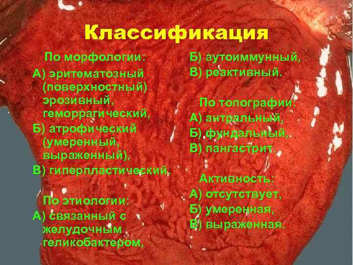 Классификация По морфологии: А) эритематозный (поверхностный) эрозивный, геморрагический, Б) атрофический (умеренный, выраженный), В) гиперпластический.