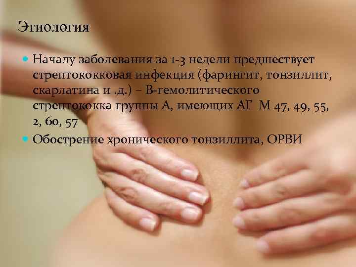 Этиология Началу заболевания за 1 -3 недели предшествует стрептококковая инфекция (фарингит, тонзиллит, скарлатина и.