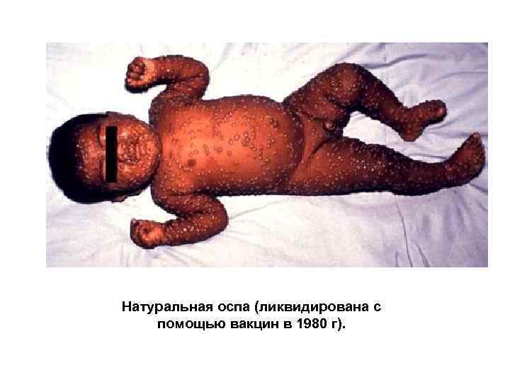 Натуральная оспа (ликвидирована с помощью вакцин в 1980 г). 