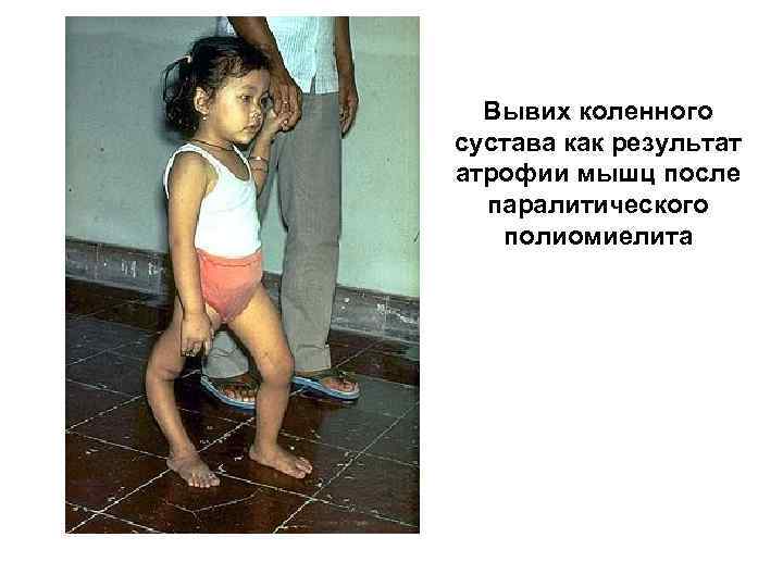 Вывих коленного сустава как результат атрофии мышц после паралитического полиомиелита 